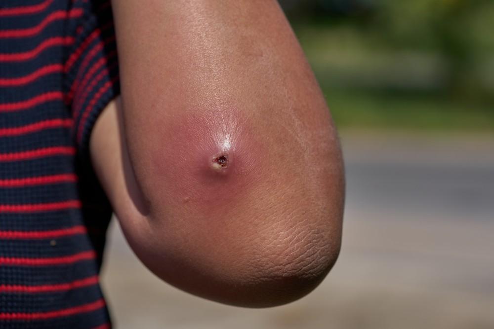 abscess treatment in HAL Indiranagar