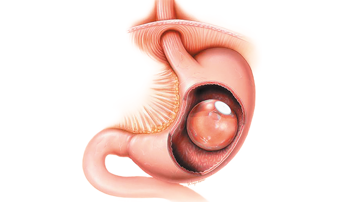  Endoscopic weight loss near HAL Indiranagar
