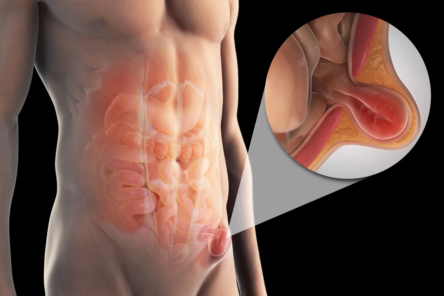 Hernia repair surgery in HAL Indiranagar
