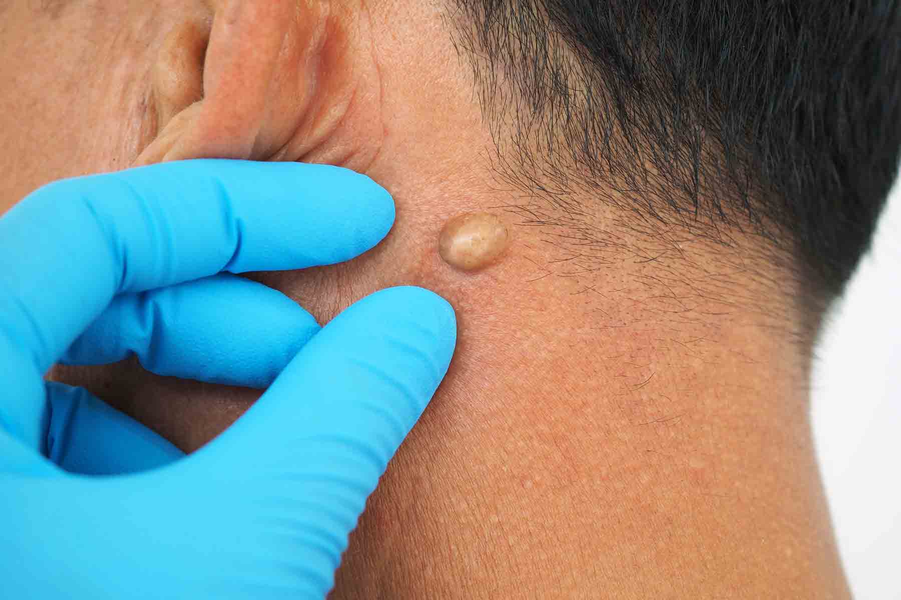 sebaceous cyst removal in Bangalore
