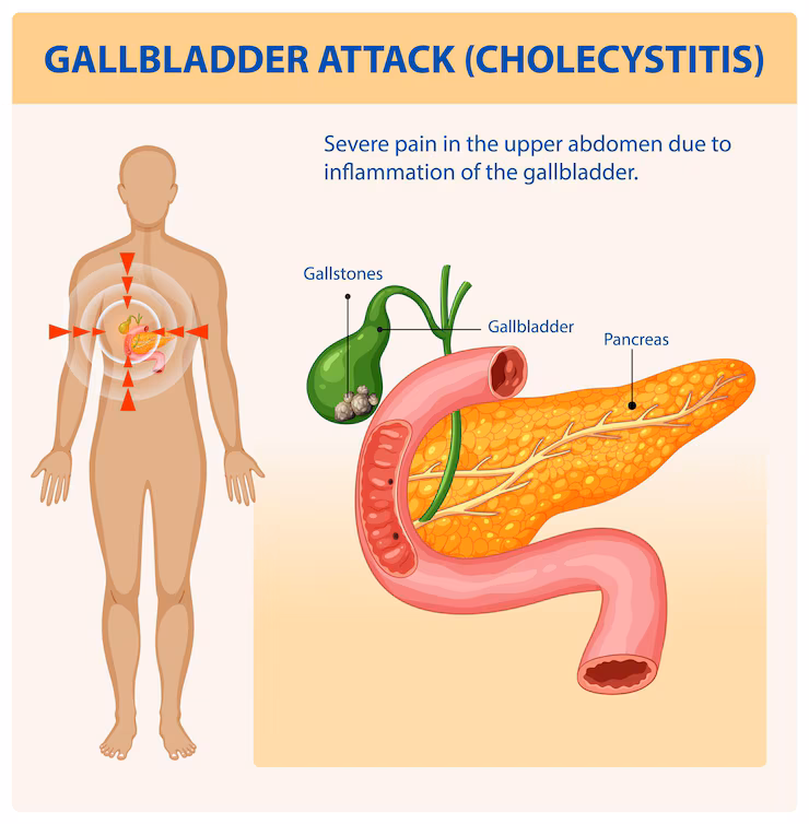  cholecystectomy in HAL Indiranagar 
